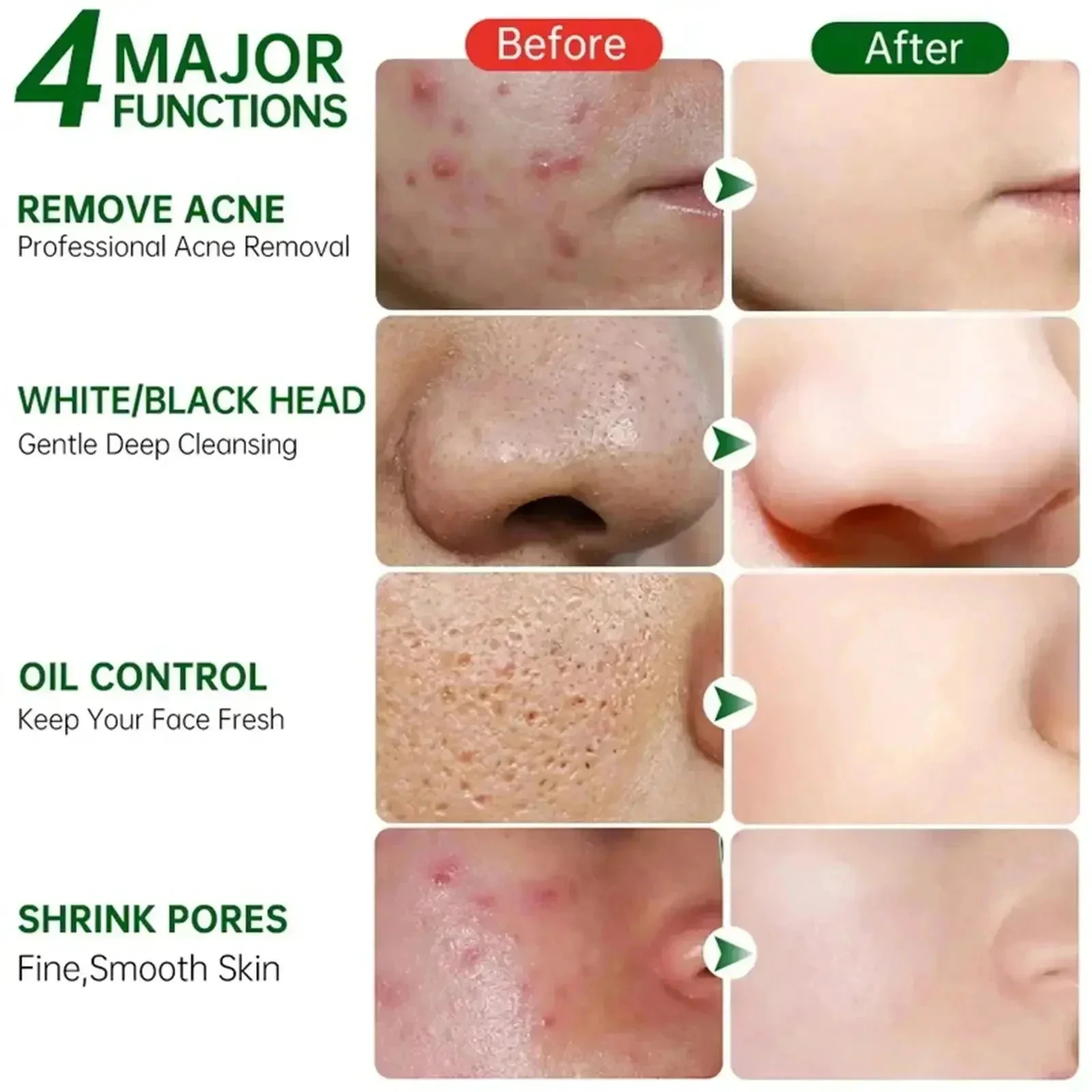 サリチル酸毛穴クリアリングクリーム毛穴を縮小黒ずみ除去にきび - Salicylic Acid Blackhead Remover のレビューと価格